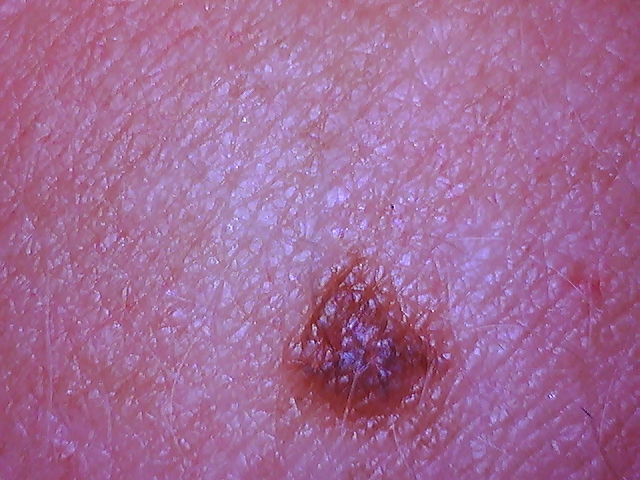 cimex-bed bugs